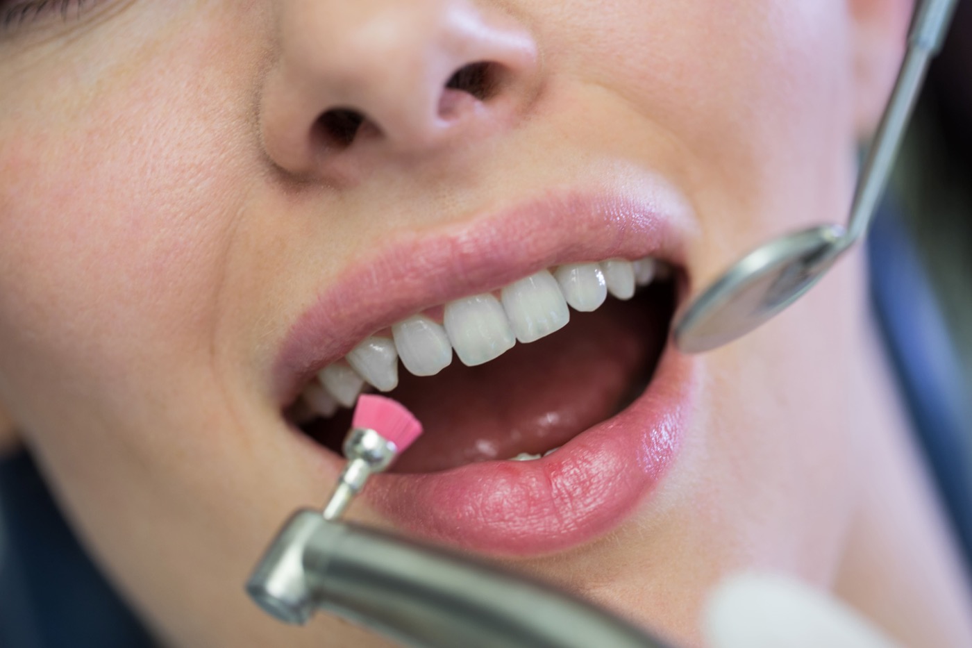 Professional dental scaling and cleaning