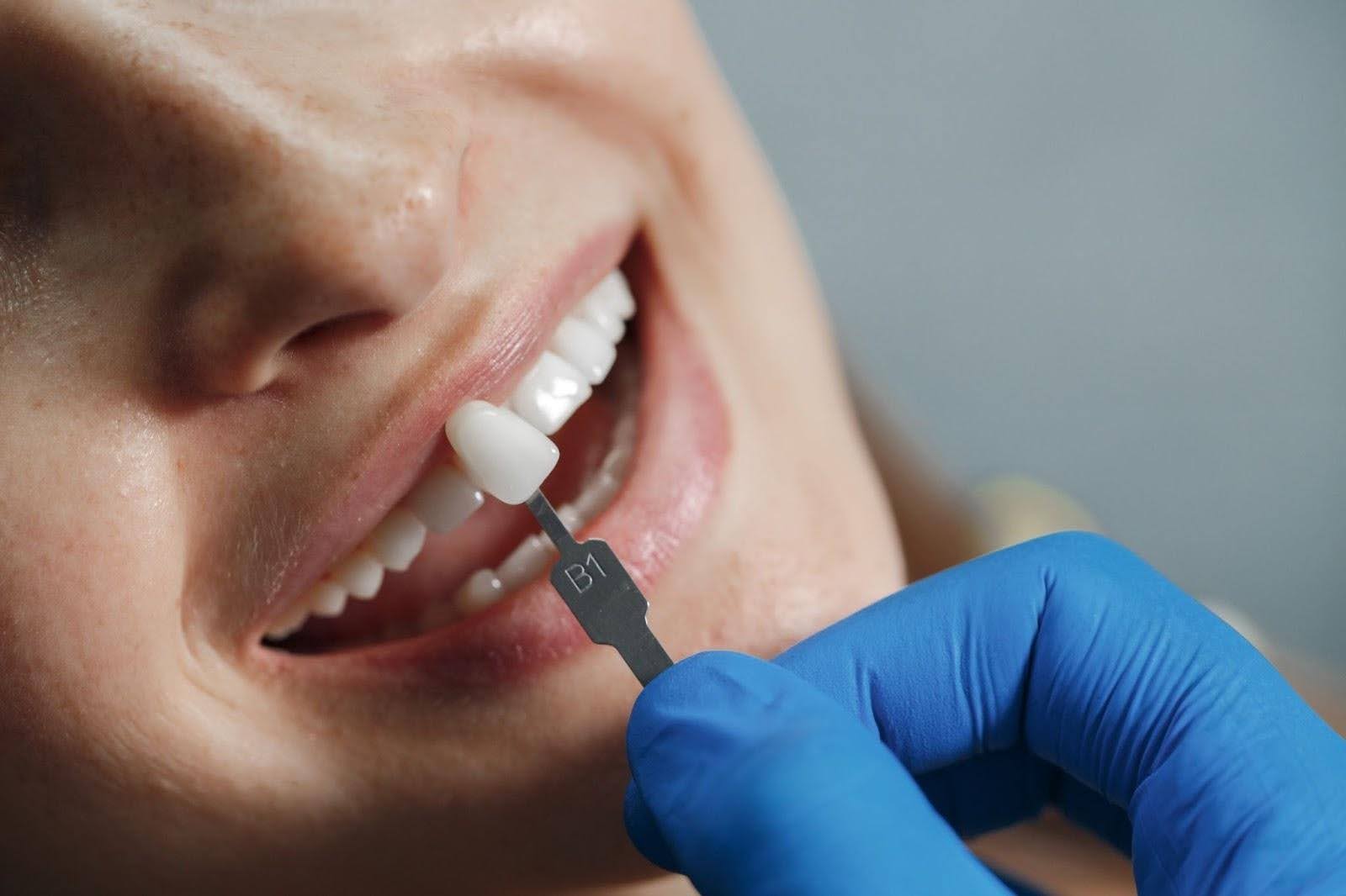 Dental tooth shade assessment